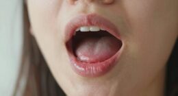 reflux causes bad breath